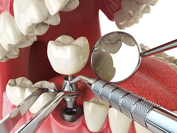 Best Emergency Wisdom Teeth Removal in Lake Dalecarlia, IN